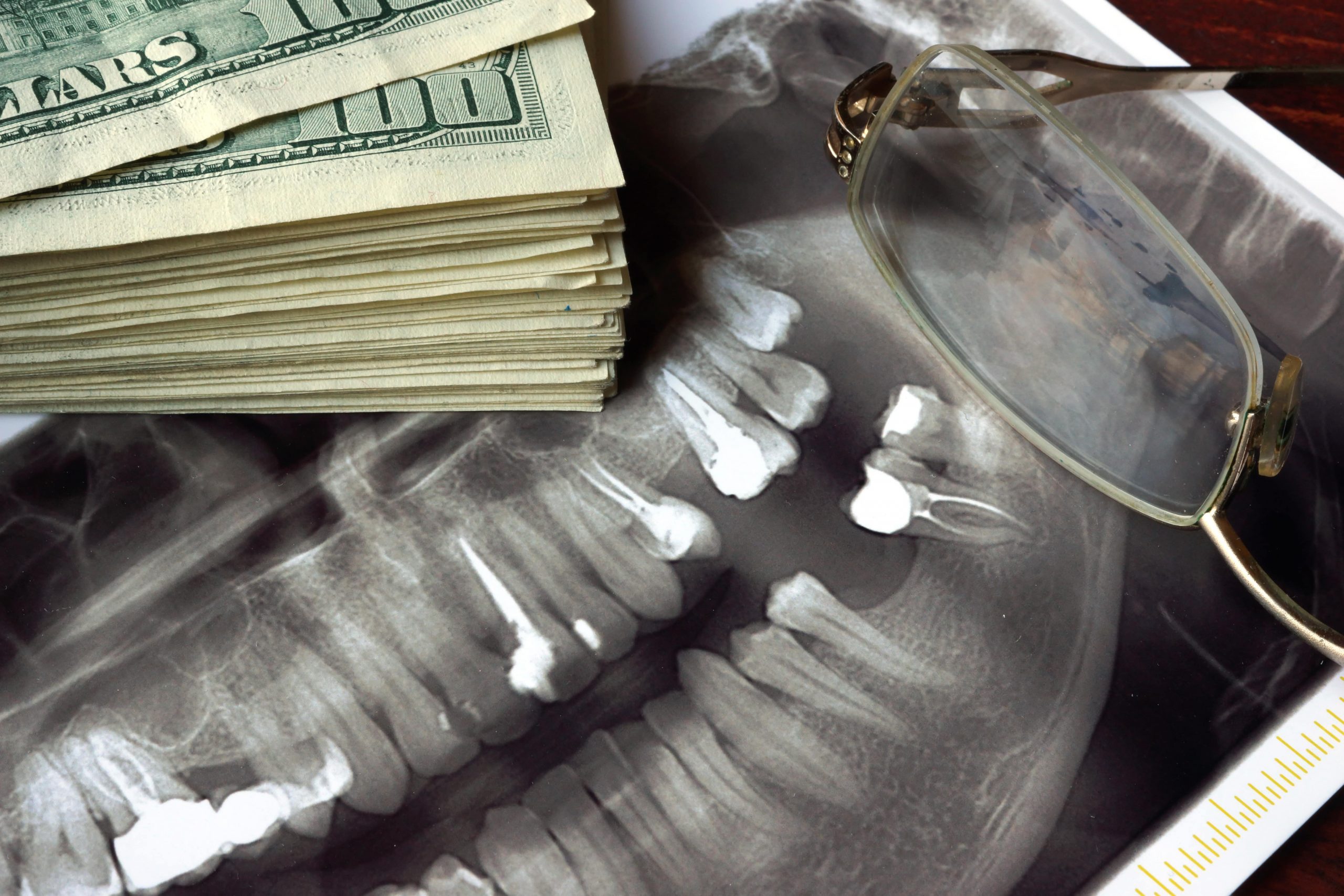 WHAT CAN I DO IF I CAN’T AFFORD THE ALL-ON-4 (DENTAL IMPLANT SUPPORTED ARCH) PROCEDURE?